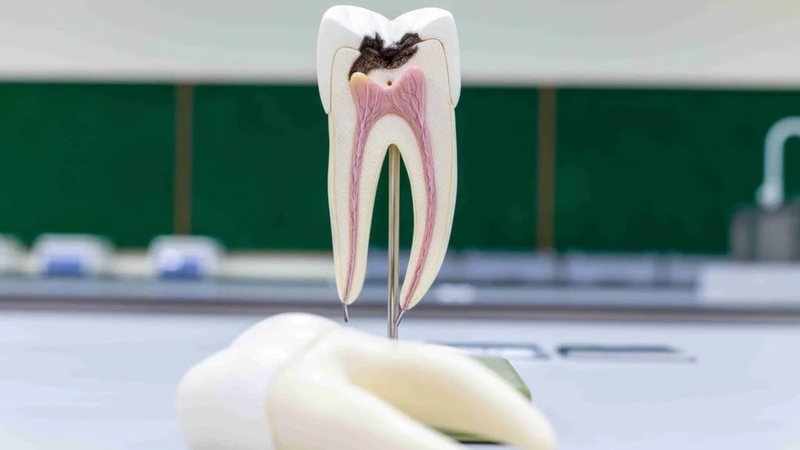 Lấy tủy răng và những thông tin cần biết trước khi thực hiện 3