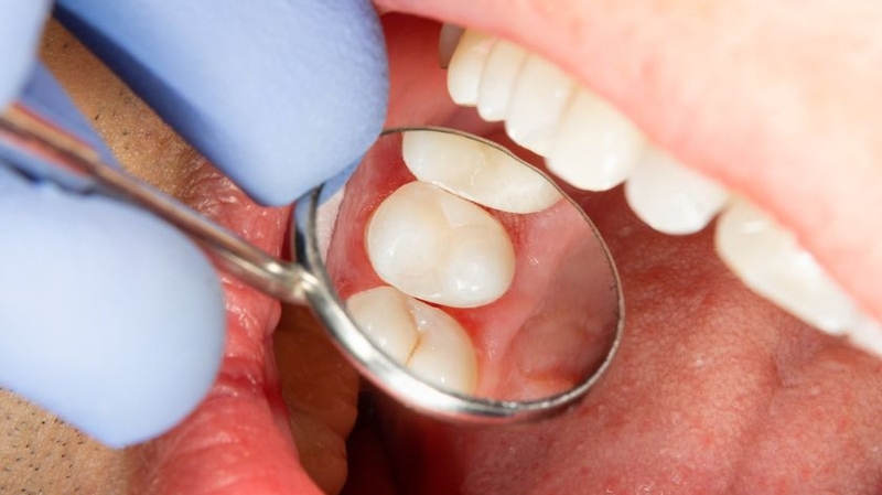 Lấy tủy răng và những thông tin cần biết trước khi thực hiện 2