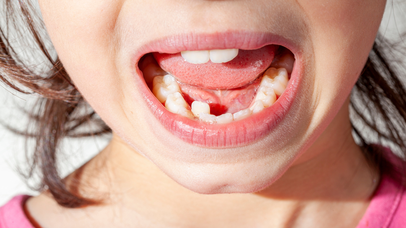 Lệch hàm là sự bất đối xứng trong cấu trúc xương hàm