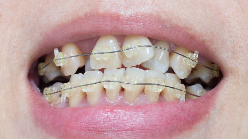 Niềng răng là một trong những cách khắc phục lệch hàm phổ biến