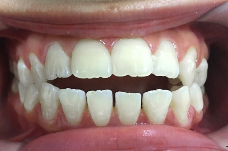 Phân loại lệch khớp cắn