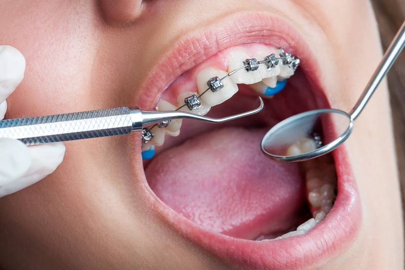 Lí giải vì sao đeo hàm duy trì vẫn bị chạy răng 3