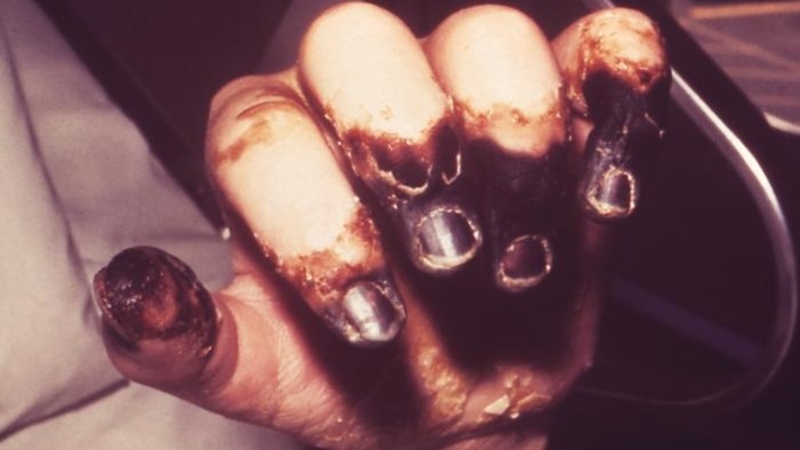 Lịch sử bệnh dịch hạch: Thảm họa cái chết đen trong quá khứ 2