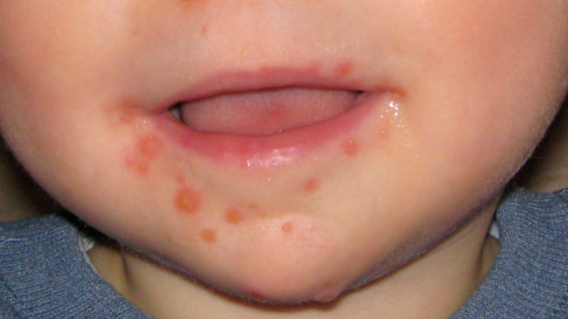 Những ca bệnh đầu tiên được ghi lại vào giữa thế kỉ XX