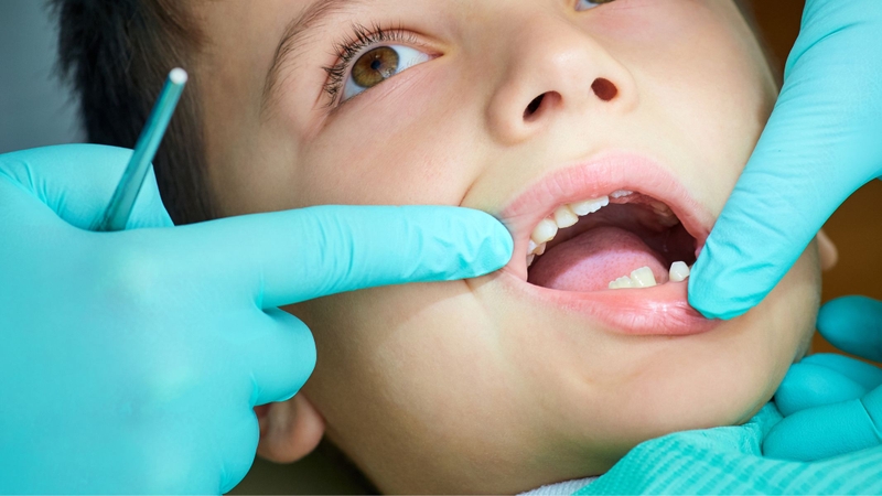 Dấu hiệu trẻ thay răng sữa gồm răng lung lay, nướu sưng đau, chảy nhiều nước bọt, khó chịu và có thể sốt nhẹ trong thời gian ngắn