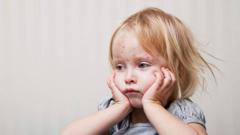 Lịch tiêm phòng quai bị cho trẻ cha mẹ cần lưu ý 1