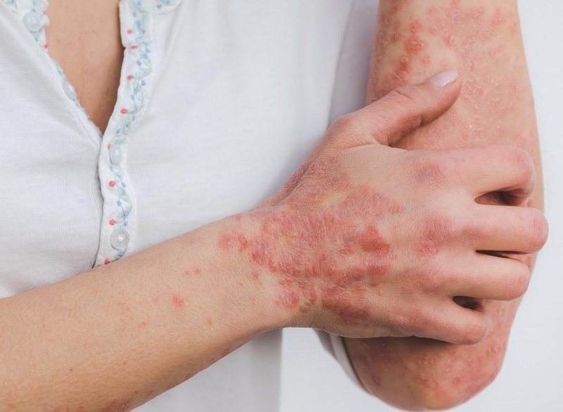 Lichen nitidus là gì? Nguyên nhân gây bệnh và phương pháp phòng ngừa 5