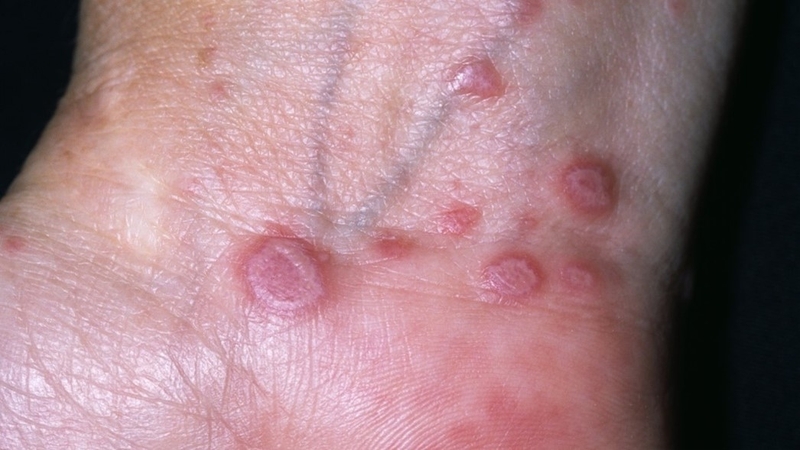 Lichen phẳng: Triệu chứng, nguyên nhân, chẩn đoán và phương pháp điều trị bệnh 1