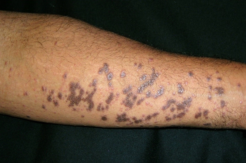 Lichen phẳng: Triệu chứng, nguyên nhân, chẩn đoán và phương pháp điều trị bệnh 2