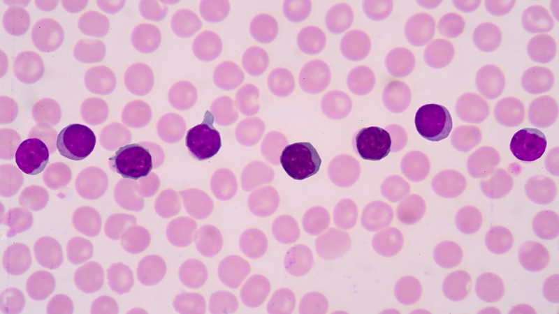 Sự gia tăng bất thường của lympho T tấn công tế bào biểu mô niêm mạc miệng, dẫn đến viêm mạn tính và tổn thương