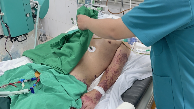 Liên cầu lợn là bệnh gì? Có nguy hiểm không 2