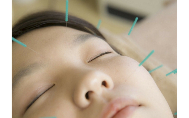 Liệt dây thần kinh số 7 châm cứu bao lâu?