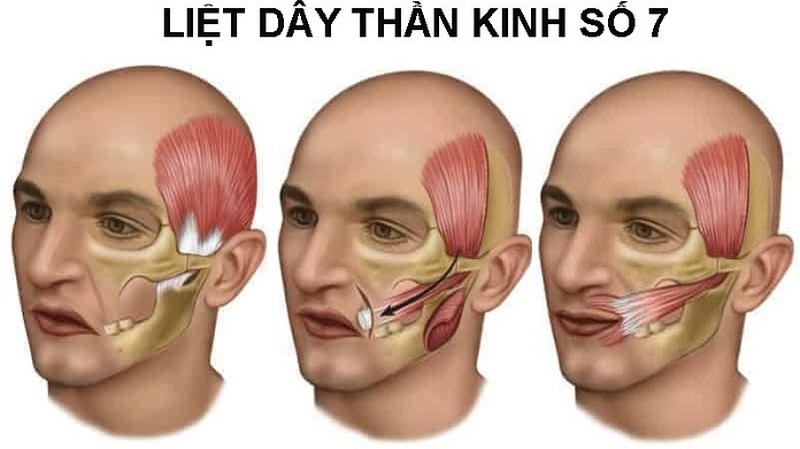 Bị liệt dây thần kinh số 7, cơ mặt có thể bị tổn thương và mất đi chức năng vận động