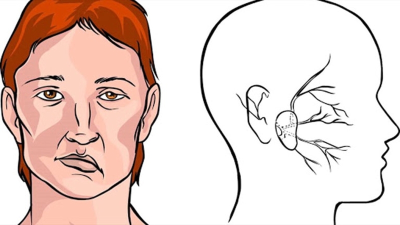 Méo một bên mặt là di chứng thường gặp của liệt dây thần kinh số 7 do tai biến