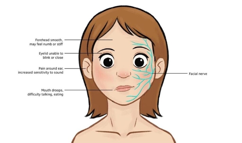 Liệt dây thần kinh số 7 ngoại biên kiêng gì – bạn đã biết chưa?1