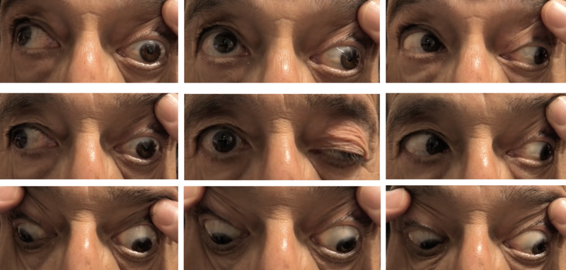 Liệt dây thần kinh số III: Nguyên nhân, triệu chứng và điều trị 2