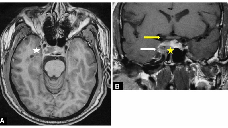 Liệt dây thần kinh số III: Nguyên nhân, triệu chứng và điều trị 3