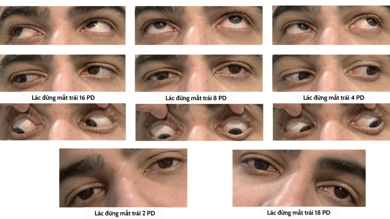 Liệt dây thần kinh số IV: Nguyên nhân, triệu chứng và điều trị 2