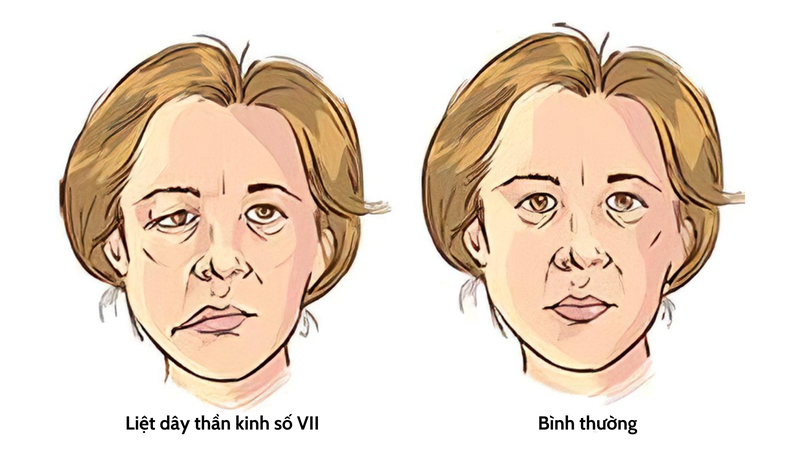 liet-day-than-kinh-so-VII-nguyen-nhan-trieu-chung-va-phuong-phap-dieu-tri 2.png