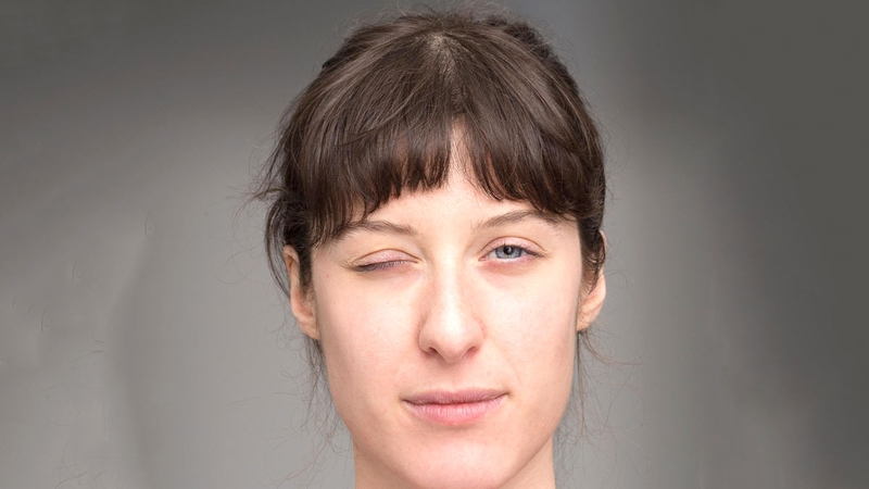 Tại sao bạn mắc bệnh liệt mặt? Cách phòng ngừa và điều trị 4