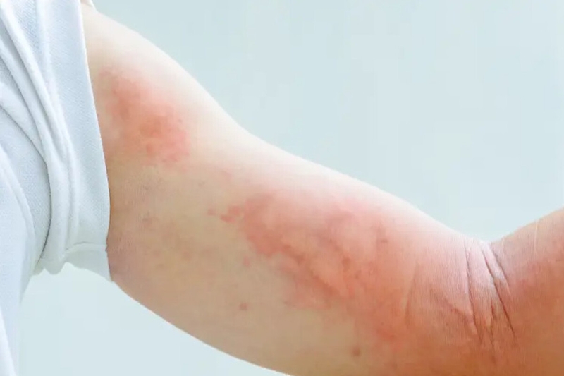 Liệu bệnh HIV có chữa được không? Nguyên tắc điều trị nhiễm virus HIV là gì? 3