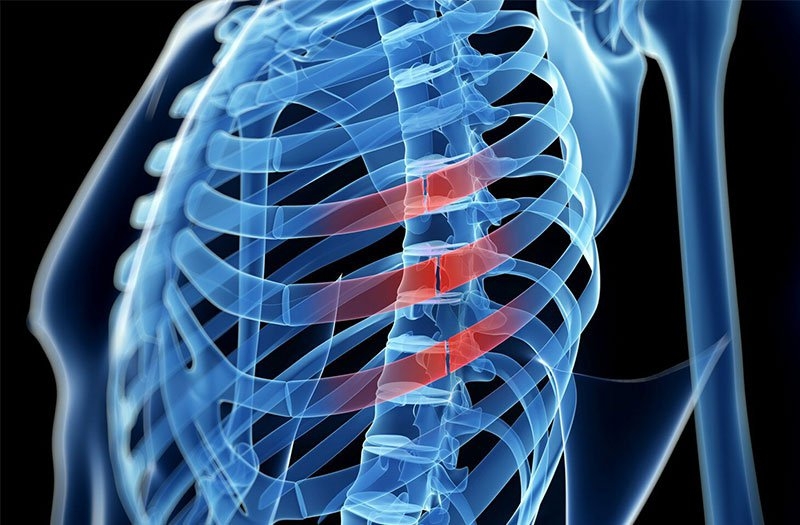 Liệu có tình trạng bong gân xương sườn hay không? 3