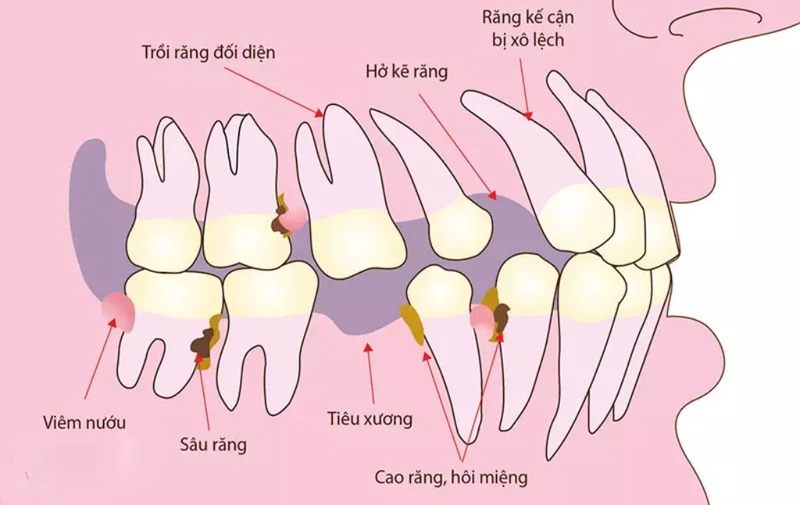 Liệu mất răng lâu năm có trồng được không? Kỹ thuật trồng răng nào tối ưu nhất? 3
