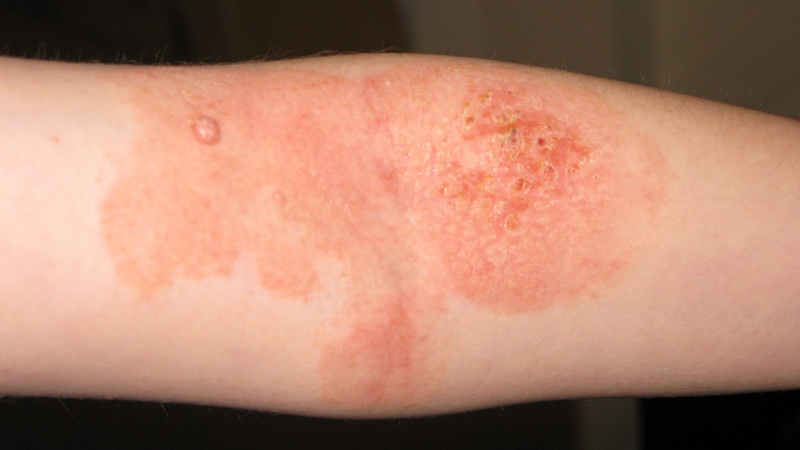 Liệu pháp miễn dịch dị ứng là gì? 3