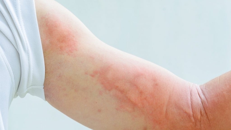 Liệu pháp thay thế Ezyme: Điều trị bệnh rối loạn dự trữ lysosome 2