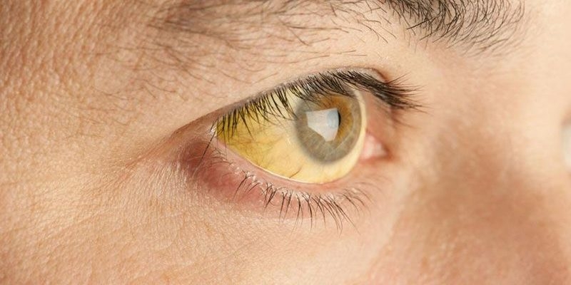 Liệu rằng ăn bí đỏ nhiều có bị vàng da không 3