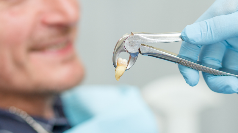 Răng sâu nặng, không thể phục hồi có thể được nhổ bỏ