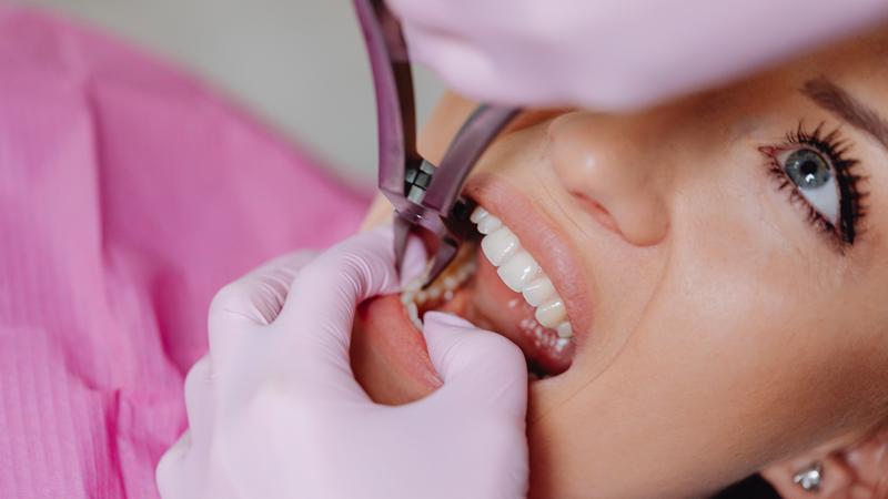 Răng gãy, vỡ nghiêm trọng do chấn thương nên được thay thế