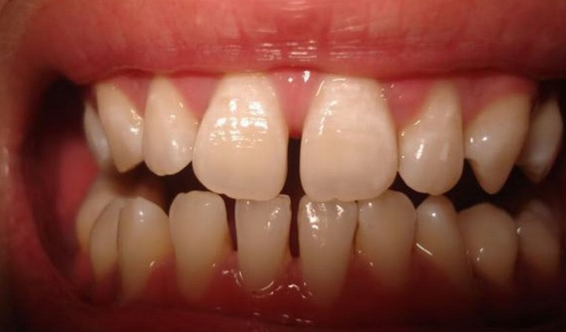 Dùng tăm xỉa răng có làm răng thưa?