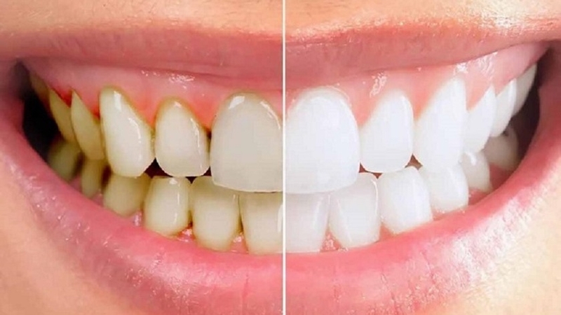 Tìm hiểu: Lấy cao răng có làm răng yếu đi hay không? 1