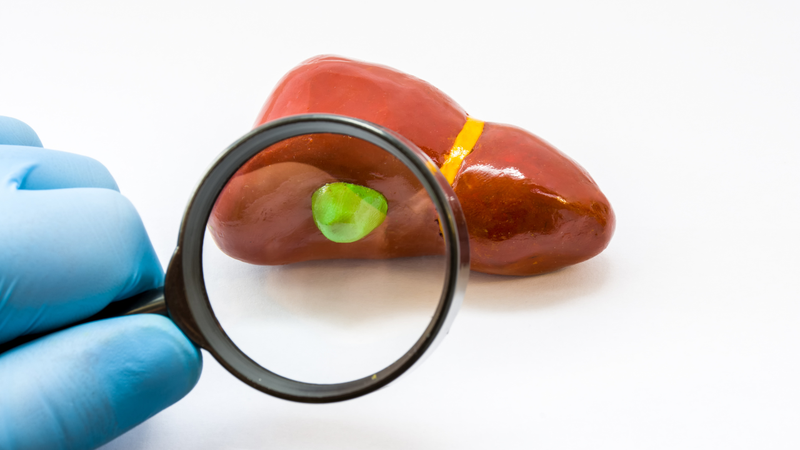 Cắt túi mật giúp loại bỏ sỏi trong túi mật, nhưng không loại bỏ hoàn toàn nguy cơ hình thành sỏi