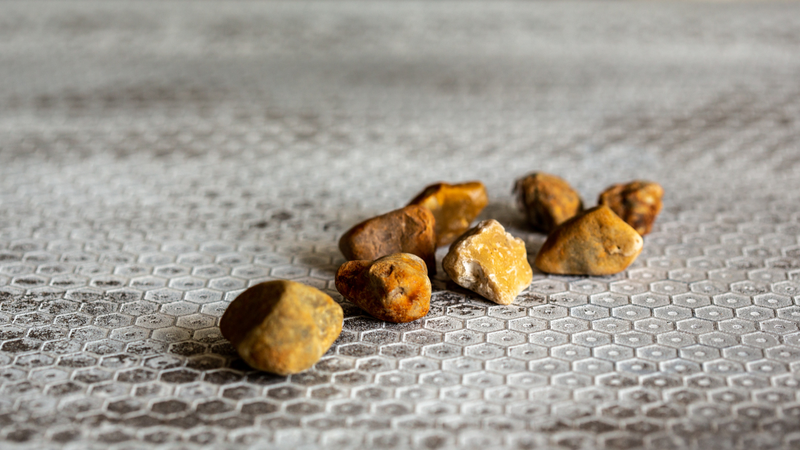 Sỏi vẫn có thể hình thành trở lại dù túi mật đã được loại bỏ