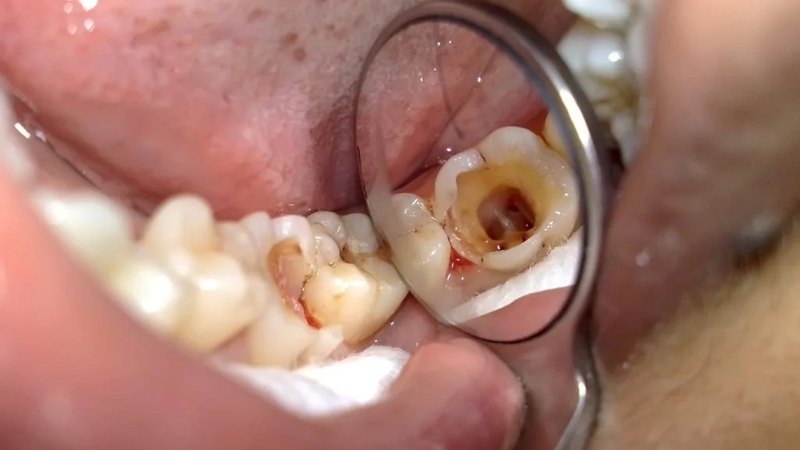 Liệu trám răng lấy tủy có đau không? 1