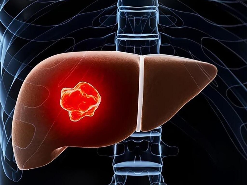 Liệu u gan và ung thư gan có khác nhau không? Làm thế nào để phân biệt hai bệnh lý này? 1