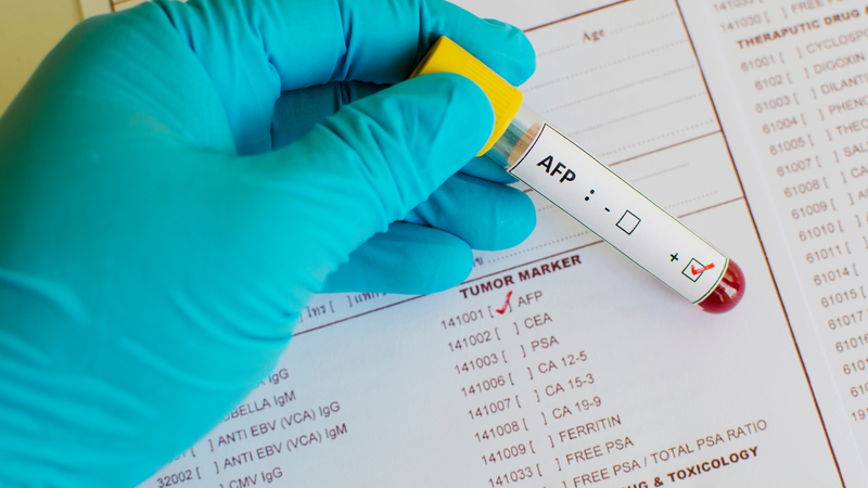 Liệu xét nghiệm máu có phát hiện bệnh gan không​? 3