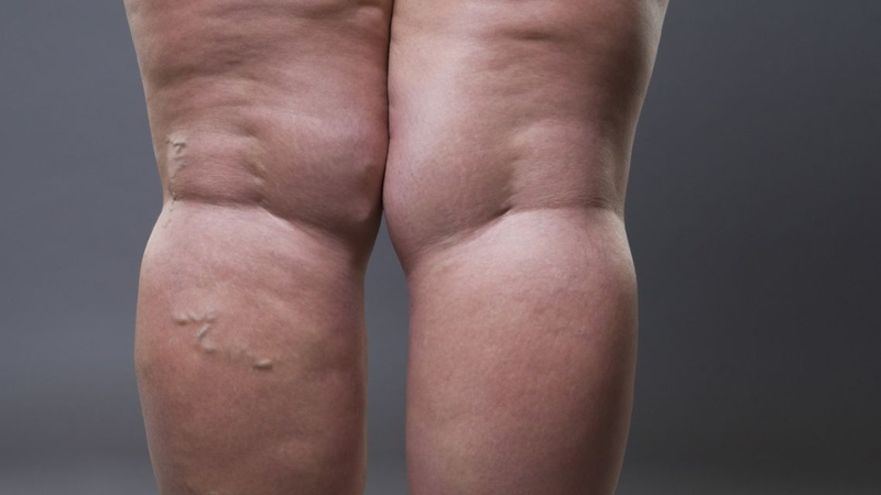 Điều trị lipedema thường kết hợp nhiều phương pháp