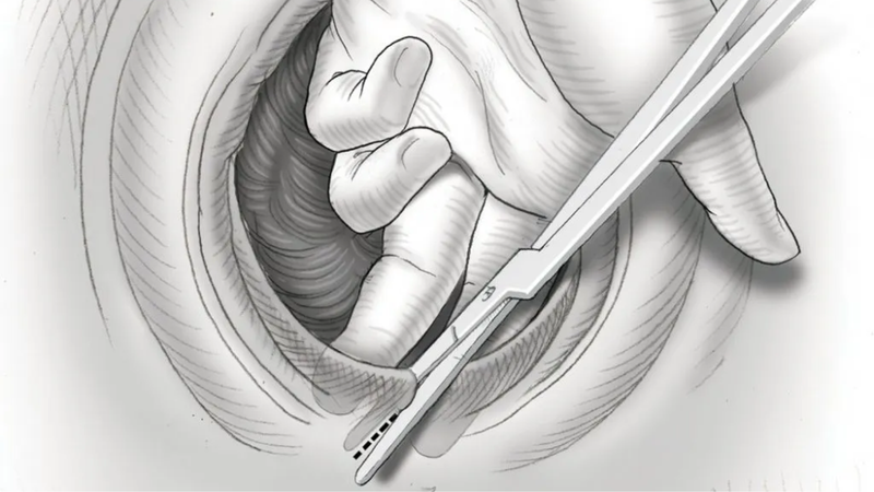 Lạc nội mạc ở âm hộ là gì? Nguyên nhân, triệu chứng và cách điều trị 2