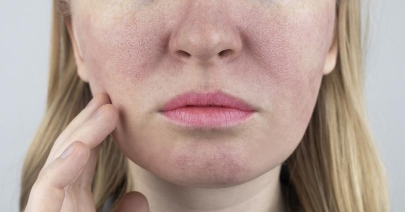 Lỗ chân lông to có nên peel da không? 1