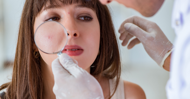 Lỗ chân lông to có nên peel da không? 4