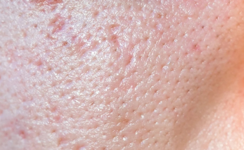 Lỗ chân lông to ở chân: Nguyên nhân, cách khắc phục và phòng ngừa 1