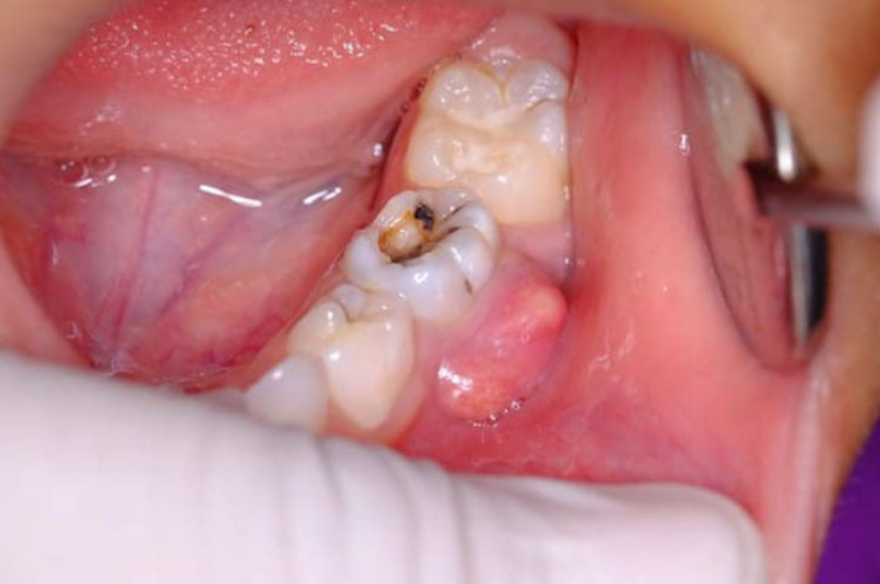 Lỗ hổng sau khi nhổ răng khôn: Nguyên nhân và cách khắc phục 2