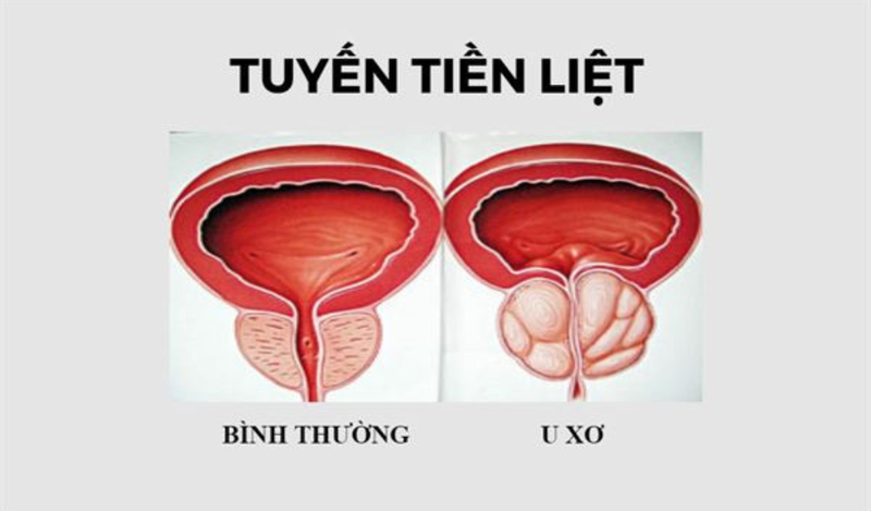 U xơ tuyến tiền liệt là gì?