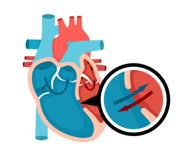 Lỗ thông liên thất bao nhiêu là bình thường? Các biến chứng của thông liên thất có thể gặp 2