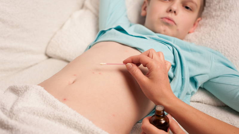 Lỡ tiếp xúc với người bị thủy đậu: Làm sao để giảm nguy cơ lây nhiễm?