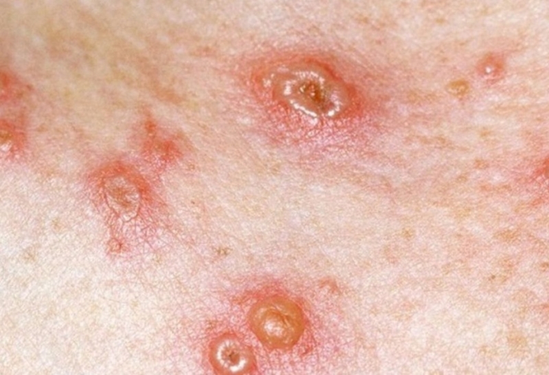 Lỡ tiếp xúc với người bị thủy đậu: Làm sao để giảm nguy cơ lây nhiễm? 2