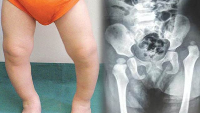 Loạn sản khớp háng có nguy hiểm không? -1